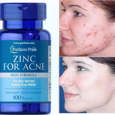 Kẽm hỗ trợ trị mụn, làm đẹp da mụn Puritan