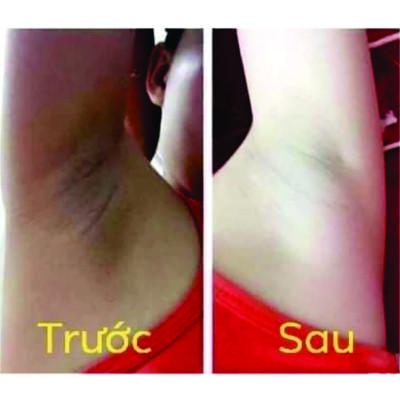 kem cô bơ thâm nách