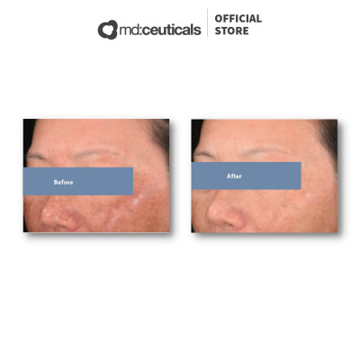 MD:TRANEX RETIPEEL – THAY DA SINH HỌC HỖ TRỢ TRỊ NÁM, SÁNG DA & CHỐNG LÃO HÓA