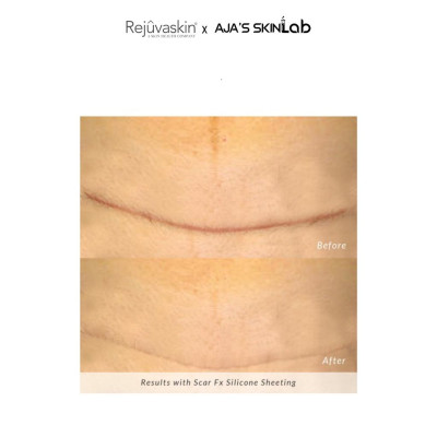 Miếng dán ngăn ngừa, nén sẹo lồi Scar FX 3.75x7.5cm REJUVASKIN - AJA