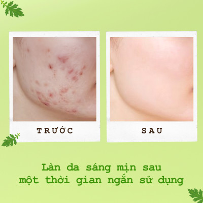 Mặt Nạ Ngủ Ngải Cứu Ngừa Mụn Sáng Da POP