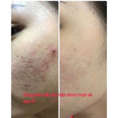 Tinh Chất Sâm Đất DR CELL 50ml tái tạo da, triệt tiêu mụn, mờ thâm nám, thu nhỏ chân lông