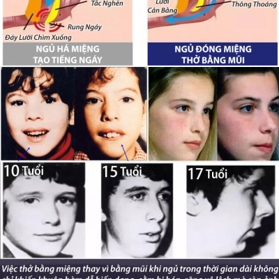 Gói 30 Miếng Dán Chống Há Miệng Khi Ngủ Giảm Ngáy Mouth Seal Băng Dính Miệng Người Lớn Trẻ Em