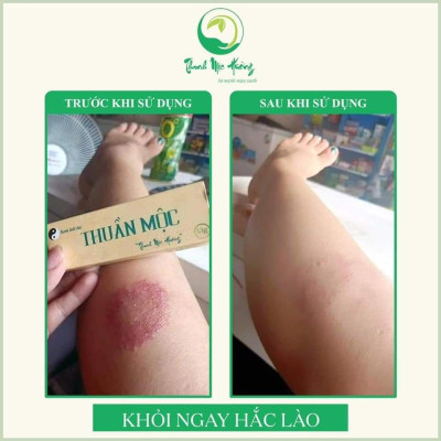 Combo kem bôi da thuần mộc ngừa rôm sảy chàm sữa nấm da đầu Thanh Mộc Hương 16g