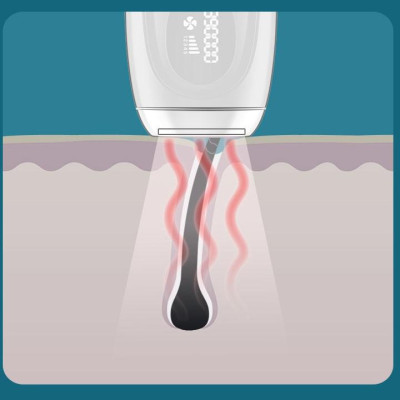 Máy Triệt Lông Vĩnh Viễn IPL - Triệt Lông Bằng Tia Lares 990000 Xung Hiệu Quả Cực Cao